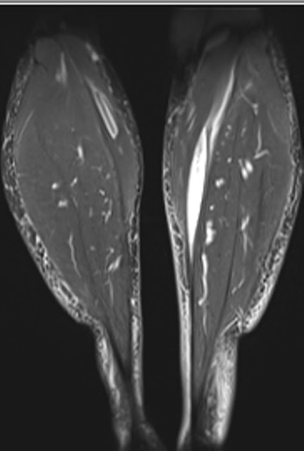 Ruptured Baker’s cyst- Pseudothrombophlebitis | The Third Eye