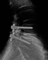 radiografía lateral de la columna con el destornillador roto