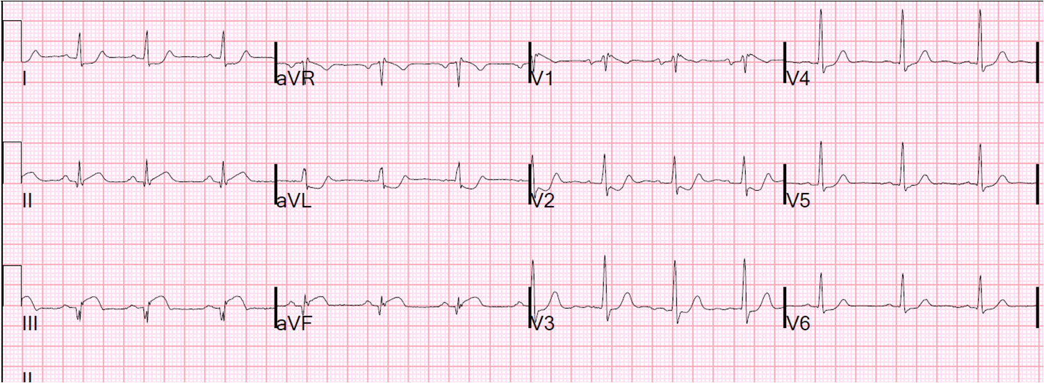 Dr Smith S Ecg Blog Inferior And Posterior Stemi What Else