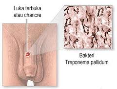 Penyakit kelamin yang disebabkan oleh bakteri treponema pallidum disebut