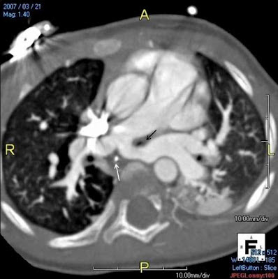 PediCardiology Quiz Answers: Quiz #6: Barium Swallow Answers