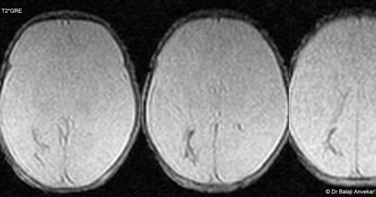 Neuroradiology Cases Germinal matrix hemorrhage MRI Brain