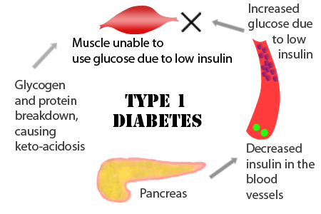 Genetic risk for type 1 diaBetes driven by faulty cell recycling