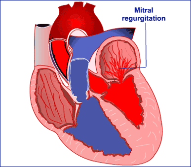 reflujo sanguíneo a través de la válvula cardíaca