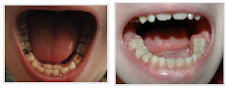 Olivia's Bottom Teeth BEFORE and AFTER