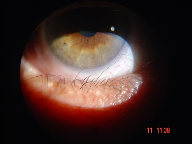 Corneal Irritation