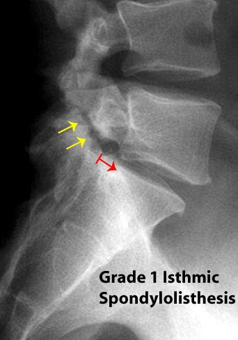 Spondylolisthesis image