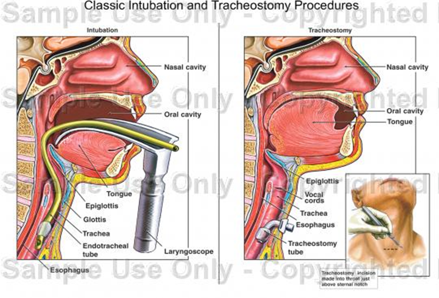 All Nurses Care Classical Intubation and Tracheostomy Procedure