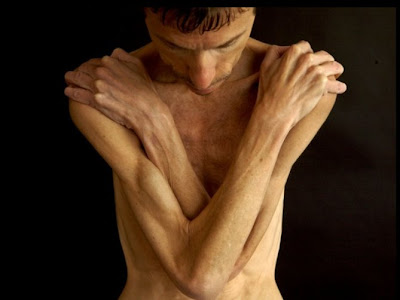 eating Anorexic+person anorexic person in world. eating Anorexic+person