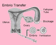 embrio transfer