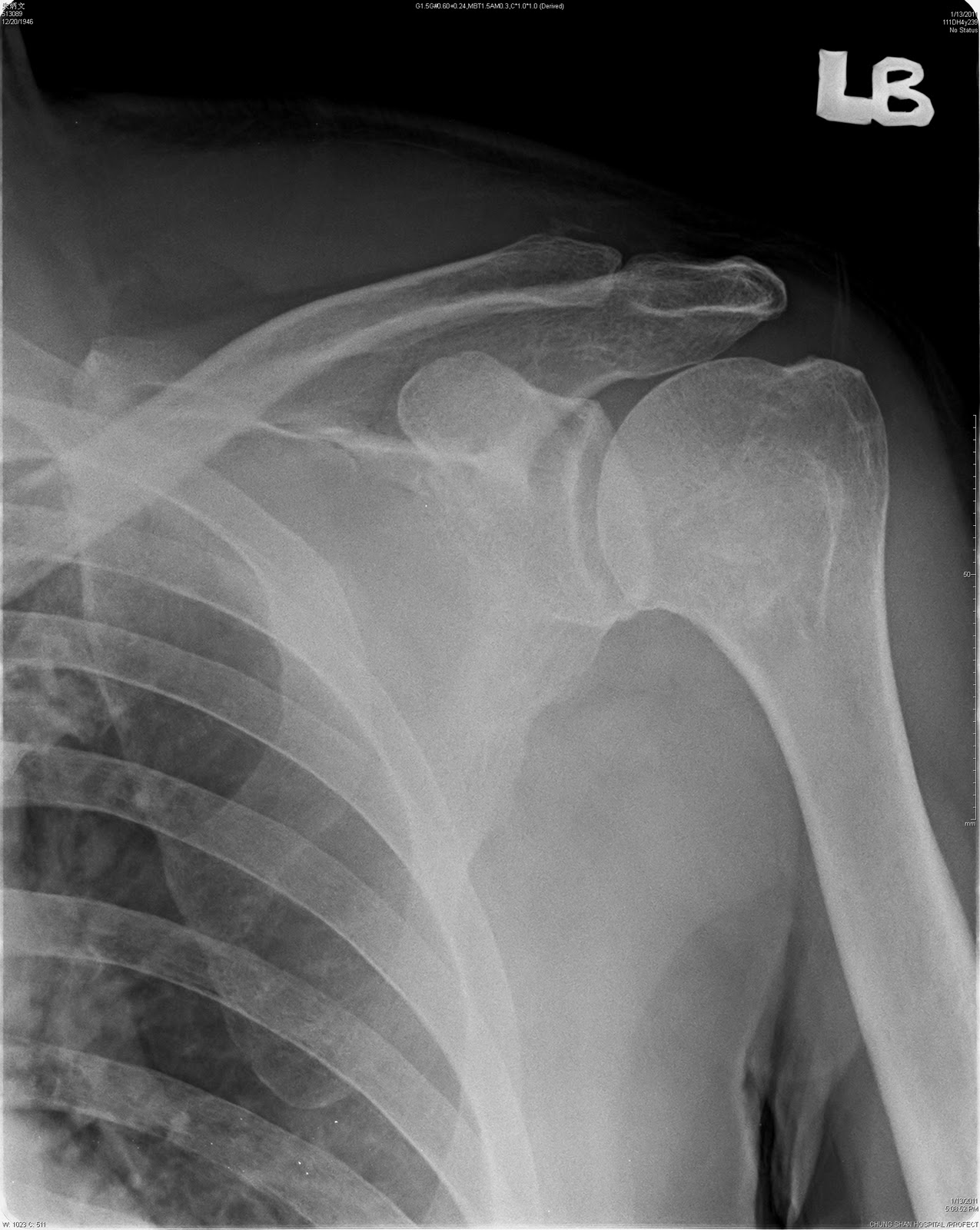 Shoulder Fracture - Fr...
