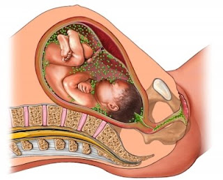 Chlamydia trachomatis infection