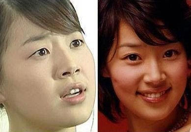 hey hey hey: [ Han Ji Hye ] Before & After Plastic Surgery