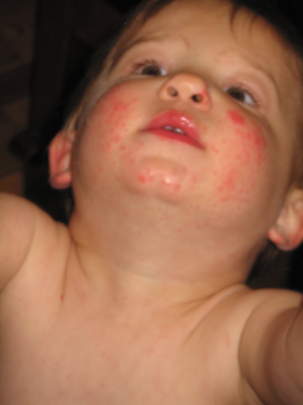 Hfmd Images