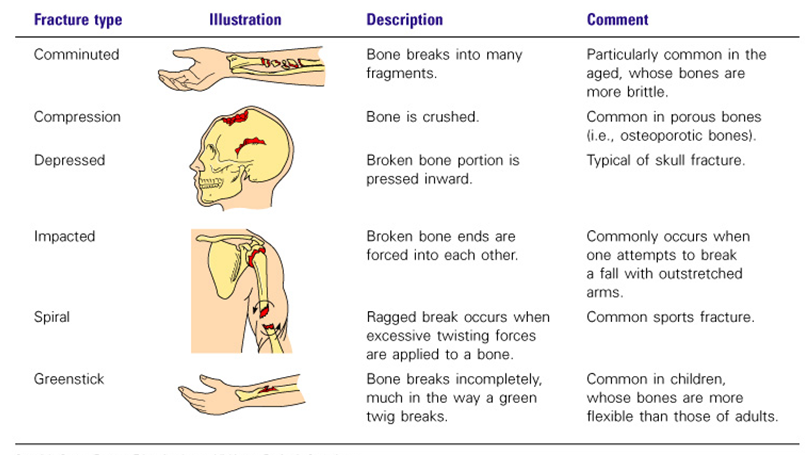 Sports, Sports Science & Physical Education: Types of Fractures