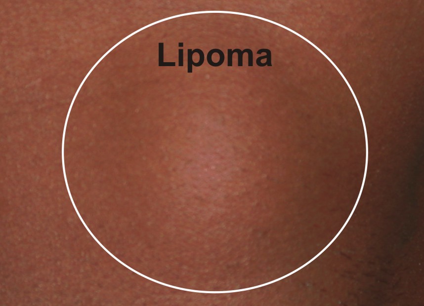HomeoConsult RD: Lipoma treatment and Homeopathy