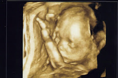 3D ultrasound- 22 weeks