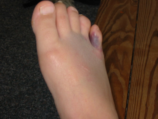 Pinky Toe Broken