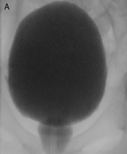 Roentgen Ray Reader SpinningTop Urethra