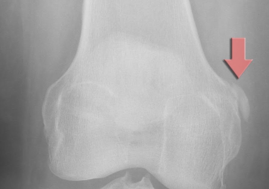Roentgen Ray Reader: Pellegrini-Stieda Disease