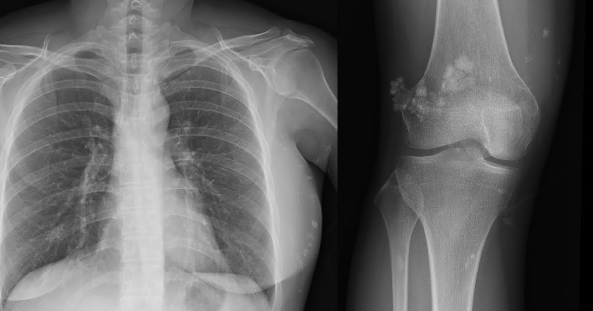 Roentgen Ray Reader Calcinosis Cutis