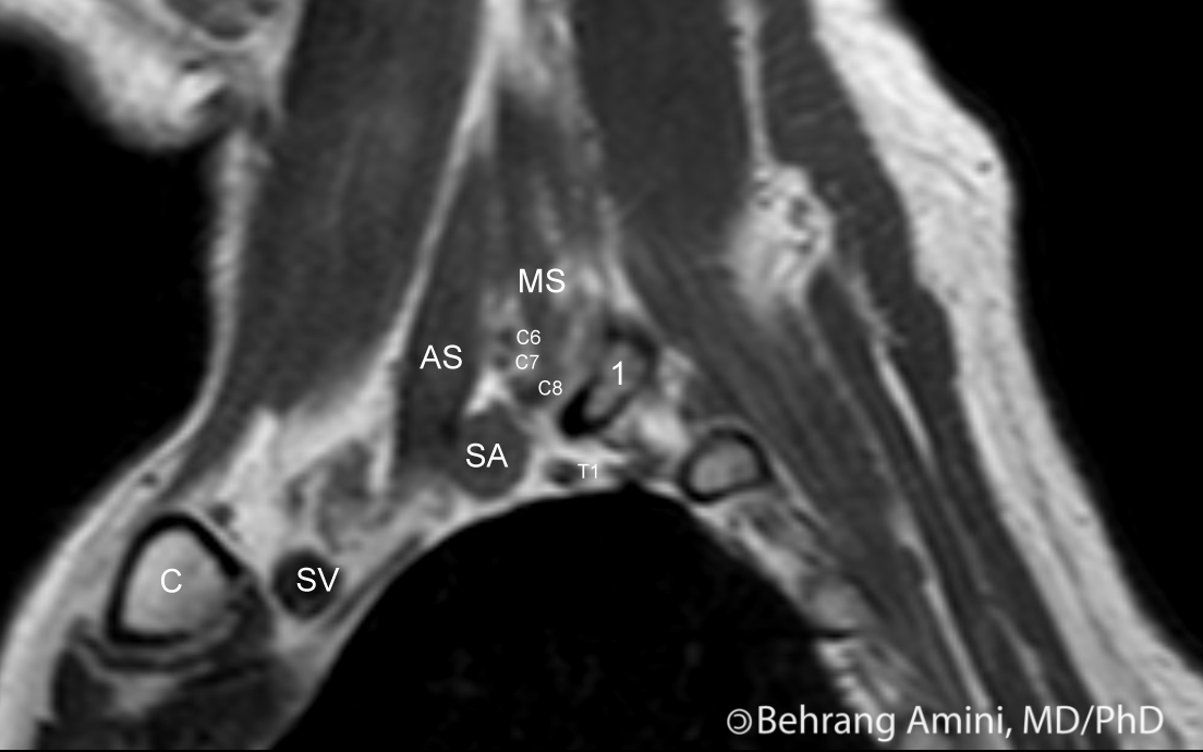 Roentgen Ray Reader Interscalene Triangle