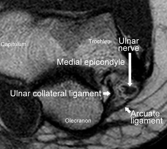 Roentgen Ray Reader Cubital Tunnel