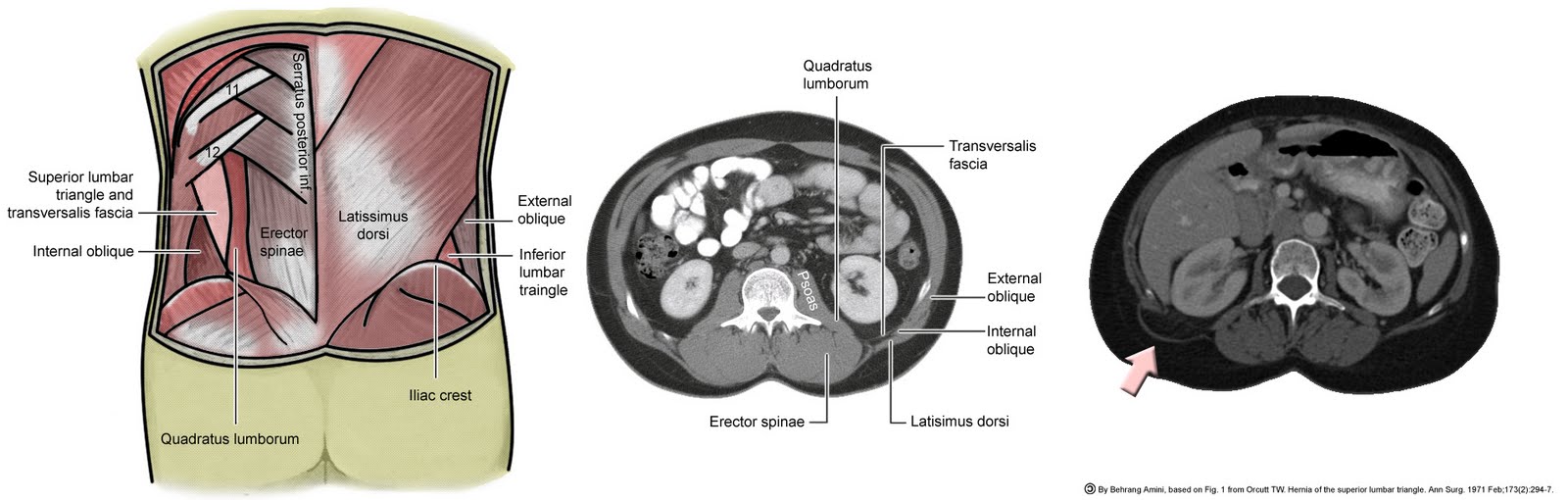 Roentgen Ray Reader GrynfelttLesshaft Hernia