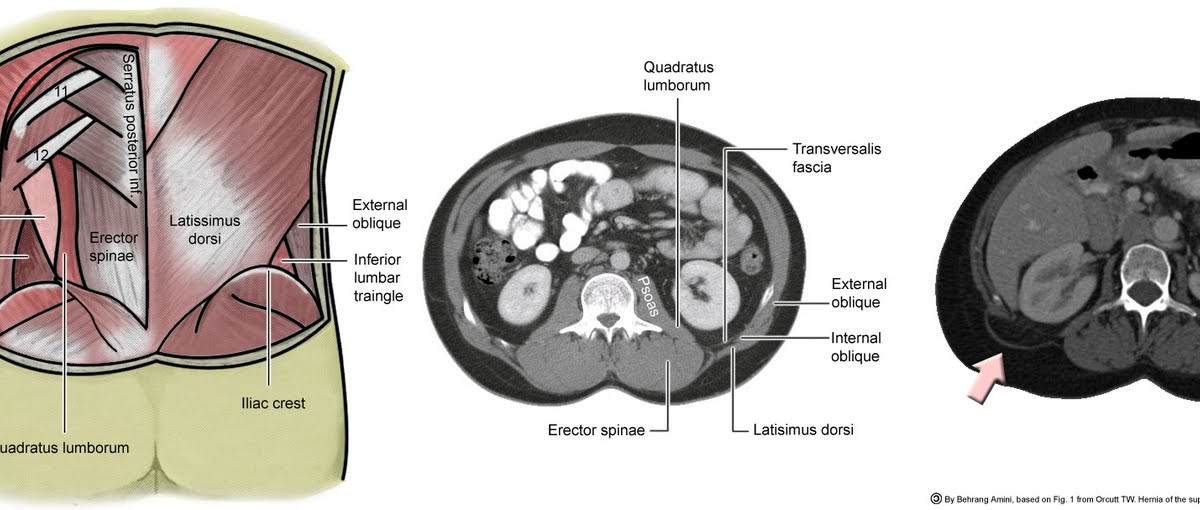Roentgen Ray Reader GrynfelttLesshaft Hernia