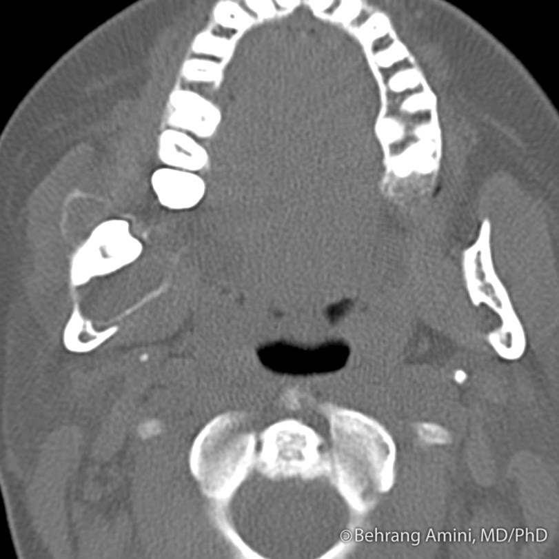 Roentgen Ray Reader BenignAppearing Bone Lesions Associated with Teeth