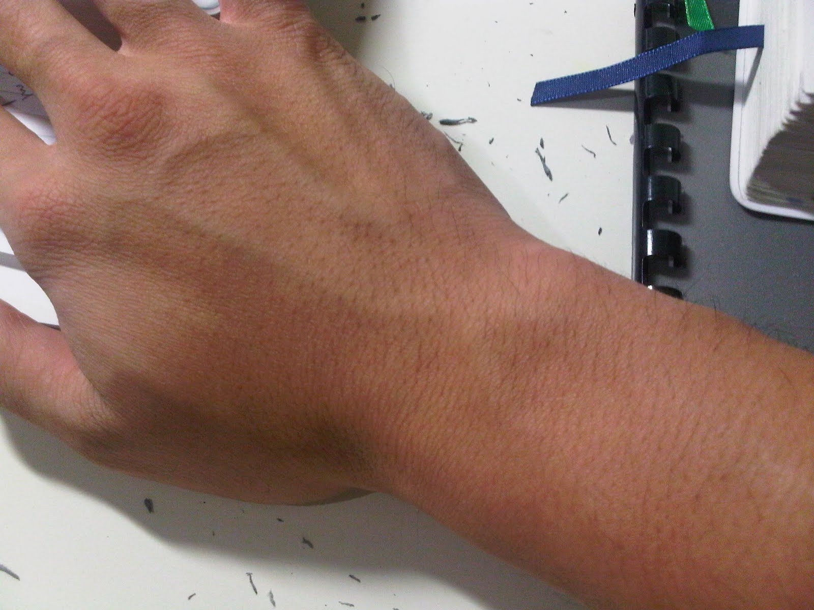 Whatablog!!: Post 10: Rheumatoid Hands