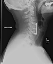 CERVICAL SPINE X-RAY
