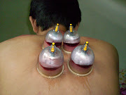 Terapi Bekam Semarang