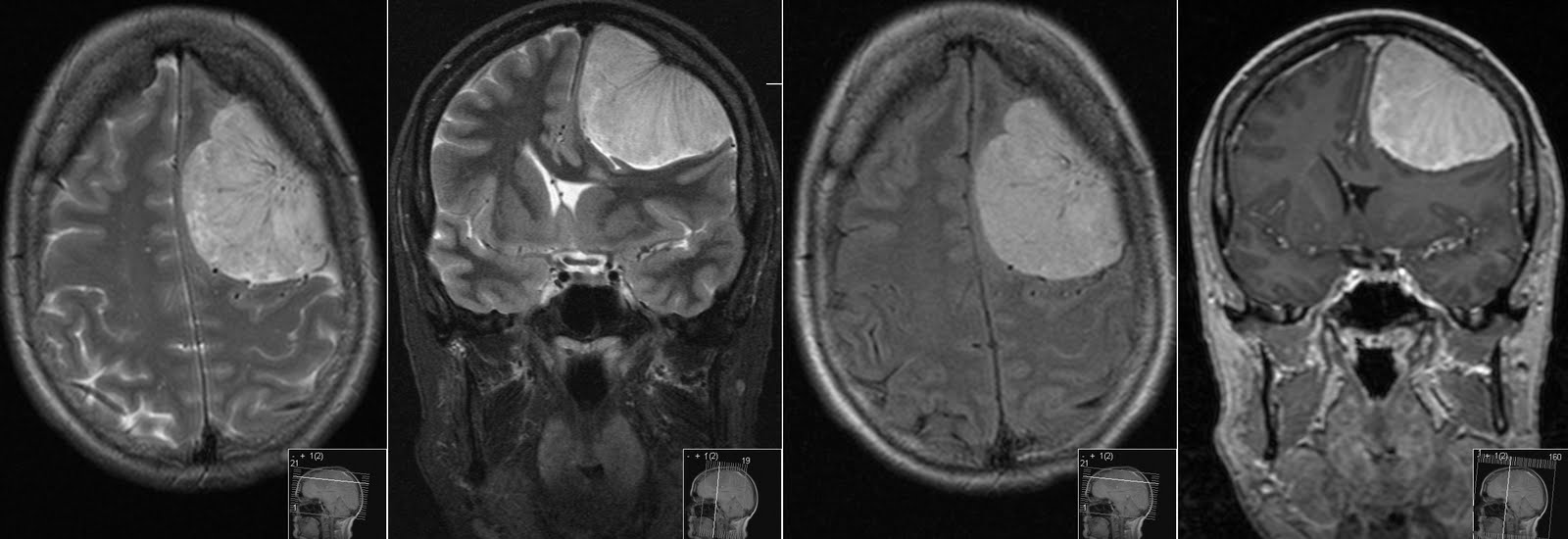 radiology mri meningioma