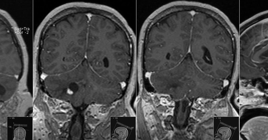 Radiology MRI Hemangioblastoma