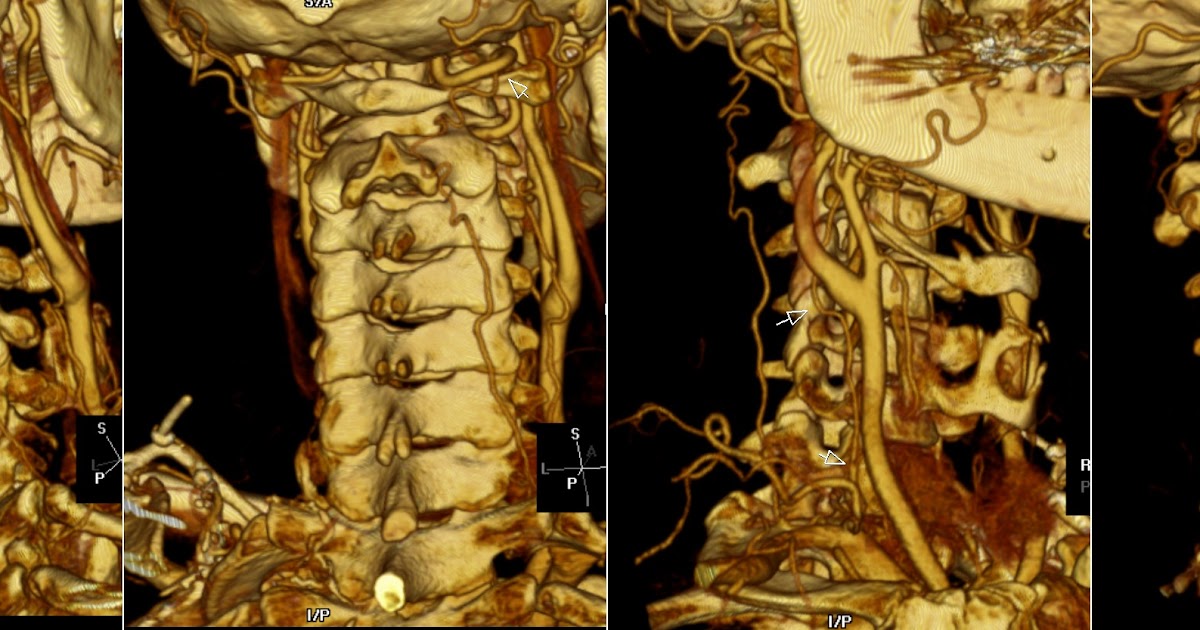 Radiology MRI Vertebral Artery Dissection Collaterals