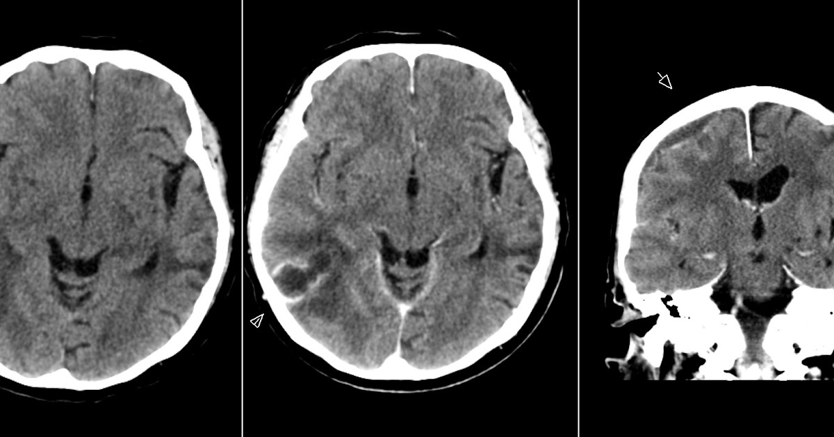 Radiology MRI Abscess and Subdural Empyema