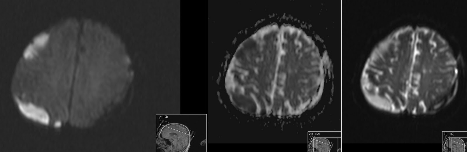 Radiology MRI Abscess and Subdural Empyema