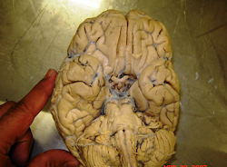 cerebro