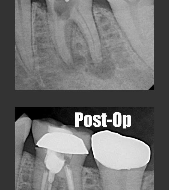 The Endo Blog Root Canal Treatment Saves a Perforated Tooth