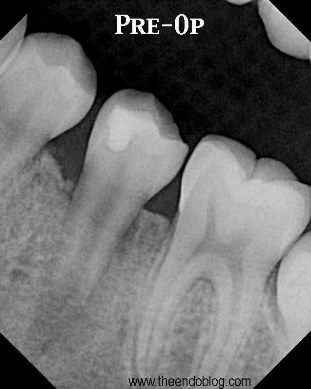 The Endo Blog Regenerative Endodontics Another Case Report
