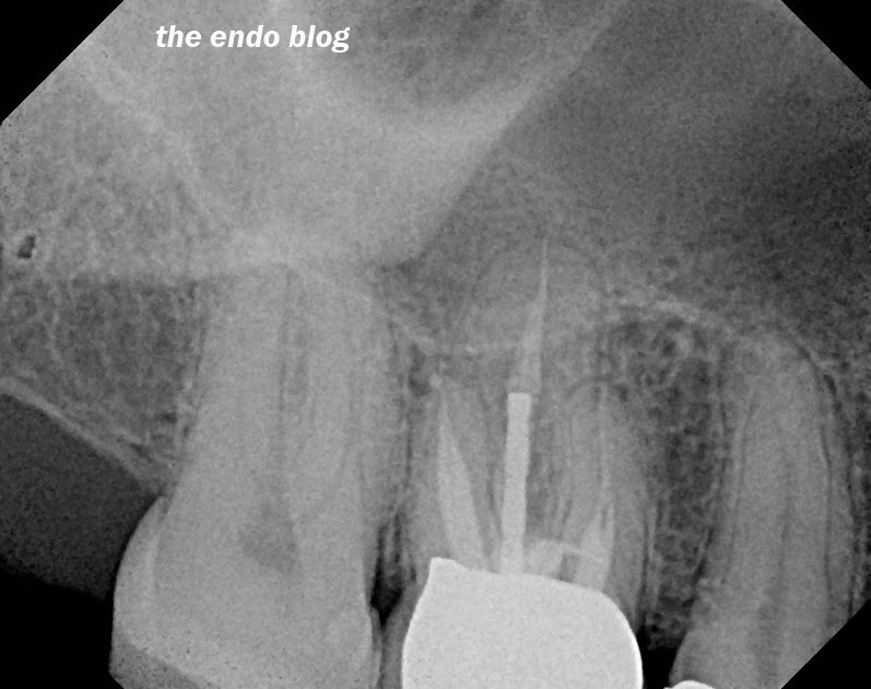 The Endo Blog Root Perforation causing Tooth Loss