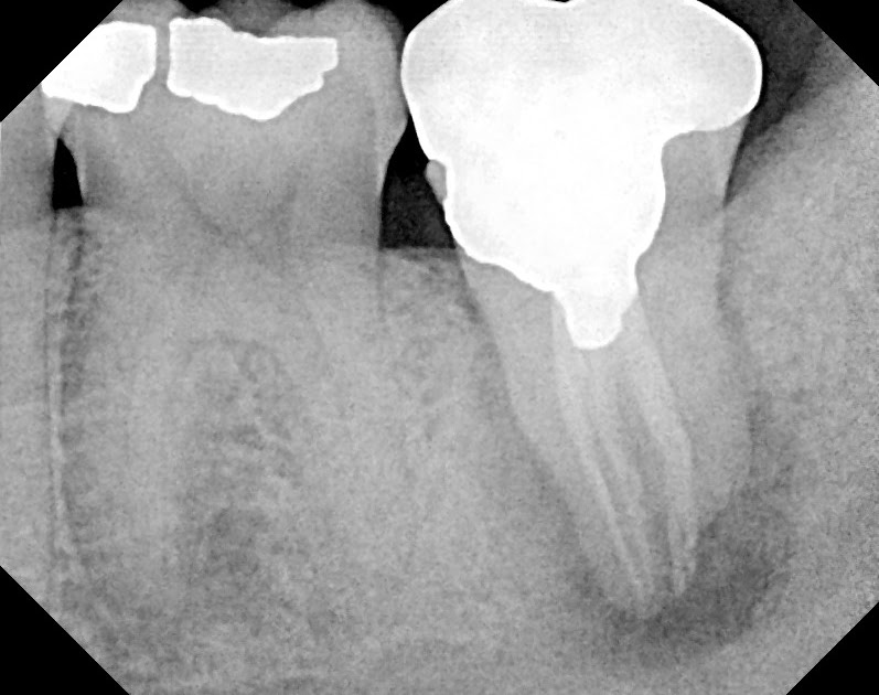 The Endo Blog Saving the Natural Tooth with Intentional Replantation