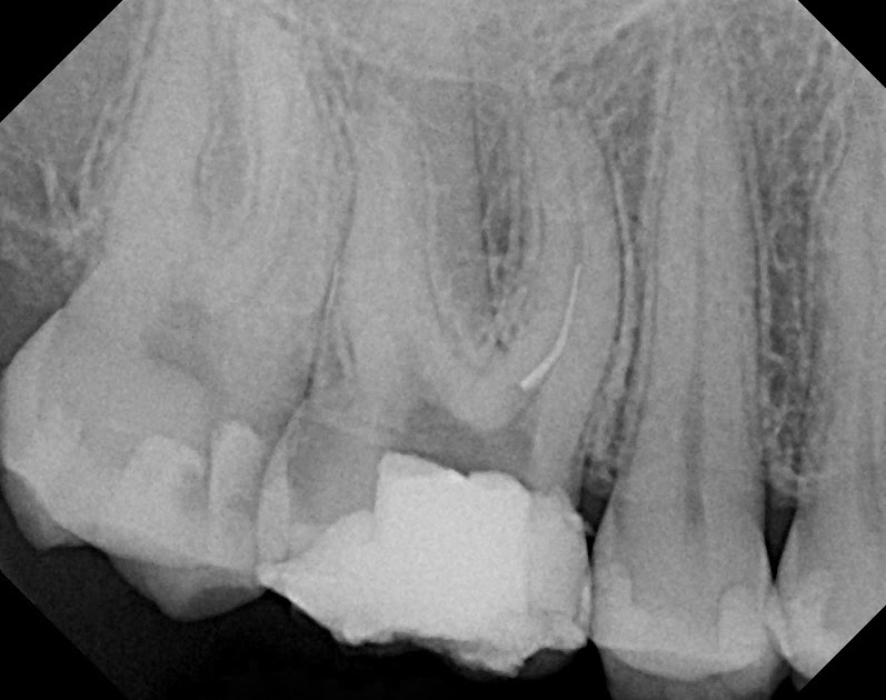 The Endo Blog Removing a Broken Endodontic File