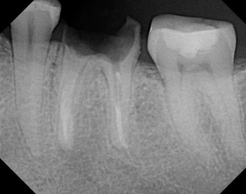 The Endo Blog The Blame Game Root Canal Failure?