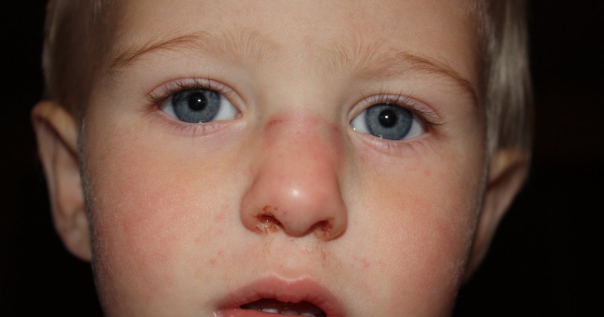 Our Forever Family Mile's Broken Nose & Love 4 Water!