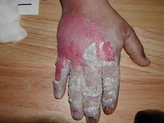 Arc Flash Burns