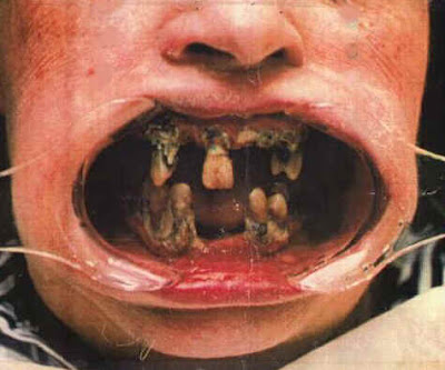bad-teeth bad-teeth