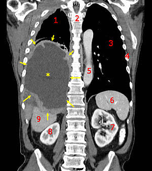 Normal+ct+scan+chest
