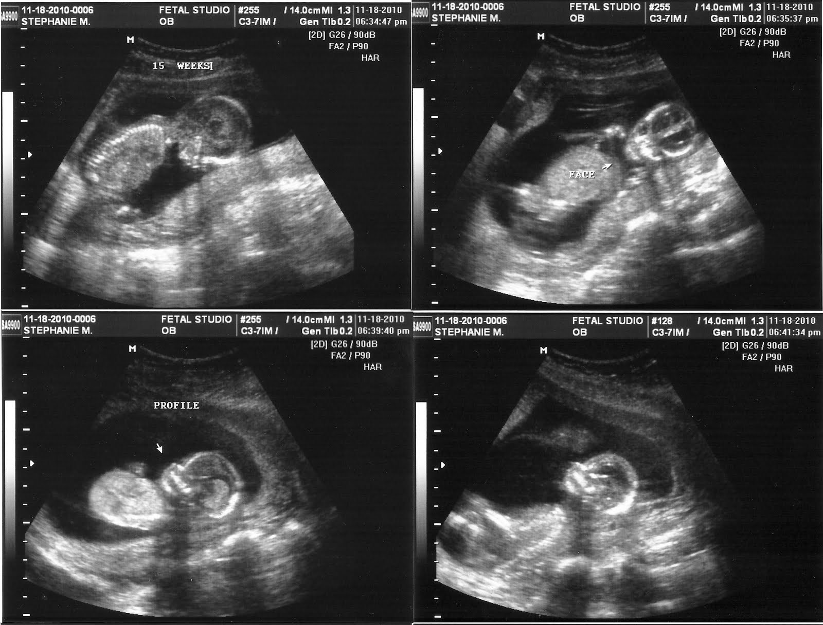 6 Weeks Pregnant (Ultrasound and Belly) 6 Weeks Pregnant (Ultrasound and Belly)